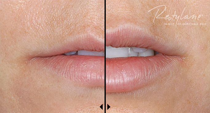 Before and After photos of Restylane