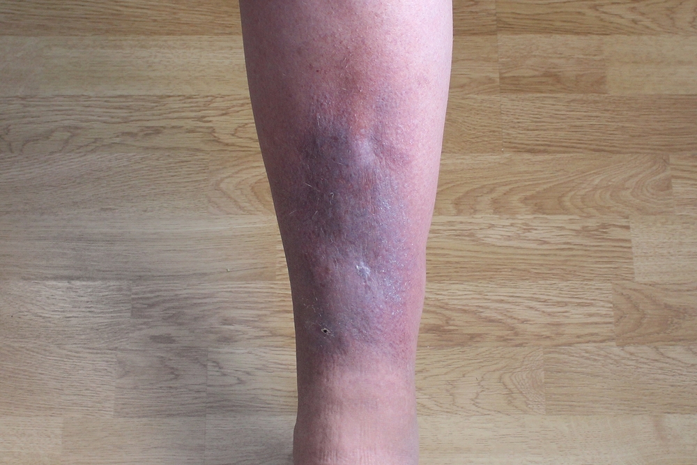 Post-Thrombotic Syndrome