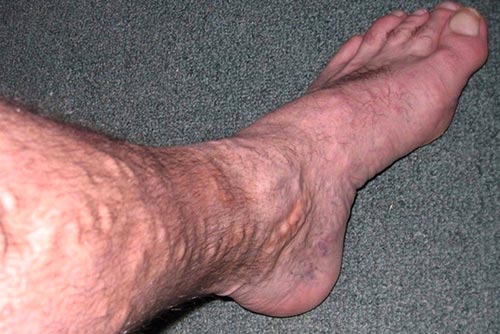 Debunking Myths About Varicose Veins