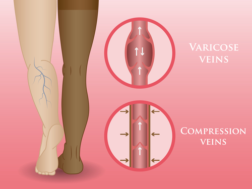 Compression Stockings for Athlete Varicose Veins