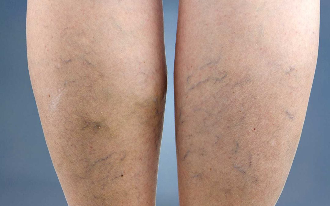 Is There a Connection Between Varicose Veins and Cardiovascular Disease?  