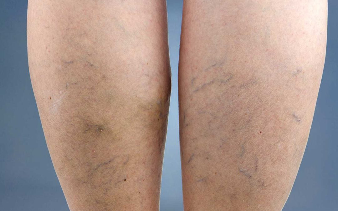 Dealing with Varicose Veins