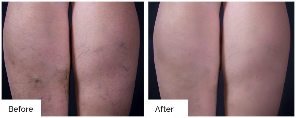 before and after spider vein treatment