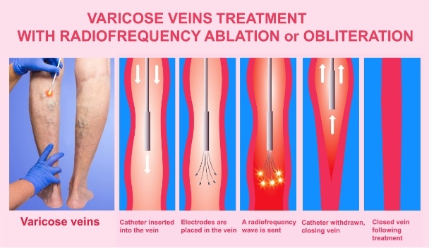 Varicose vein treatment