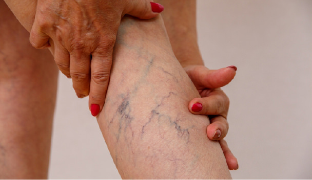 Varicose Veins