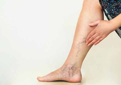 Leg with Varicose veins