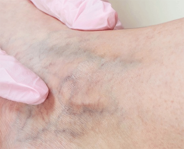 Upclose of Varicose veins