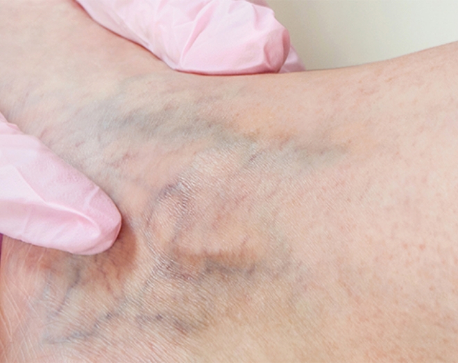 Varicose Veins